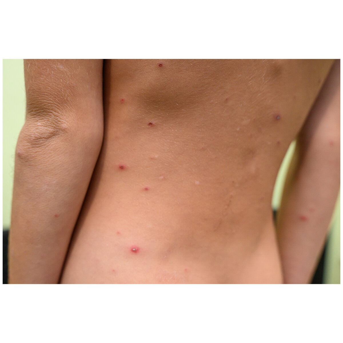 Itchfix Soothing Gel 2 x 75g