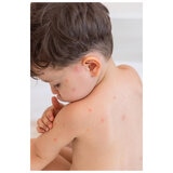 Itchfix Soothing Gel 2 x 75g